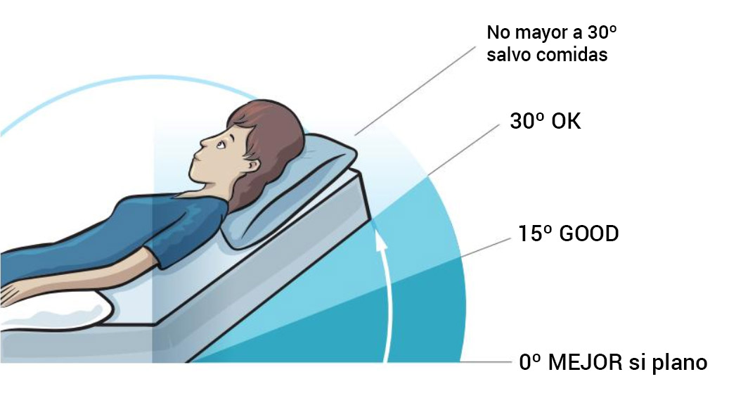 Diagrama mostrando la inclinacion ideal para una cama hospitalaria durante el tratamiento para úlceras Por presión Ángulo no mayor a 30º salvo comidas 30º OK 15º BIEN 0º MEJOR